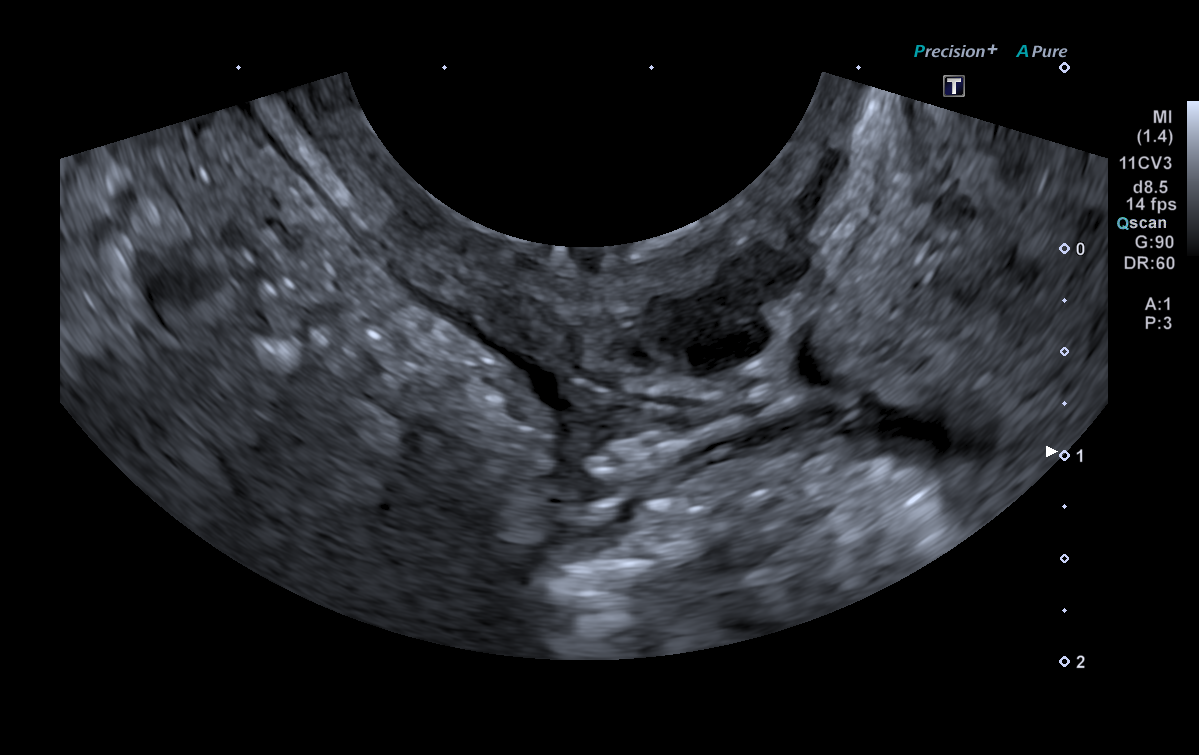 endometrioza